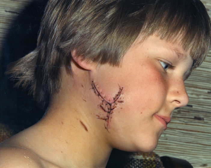 David Codr dog bite.jpeg